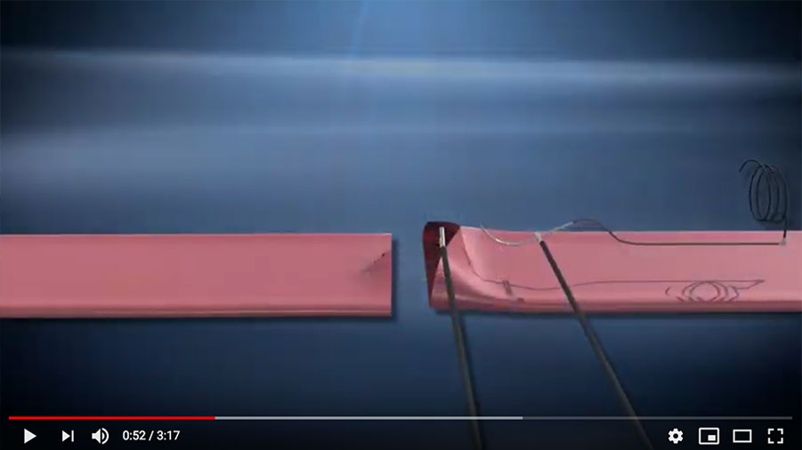 Smart Sutures 3D Medical Animation